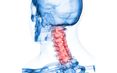 Spondilosi cervicale: cosa è?